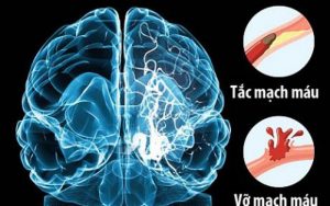 Dấu hiệu đột quỵ cực nguy hiểm ai cũng bỏ qua