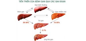 Việt Nam đứng thứ 3 thế giới về ung thư gan - cách phát hiện bệnh gan
