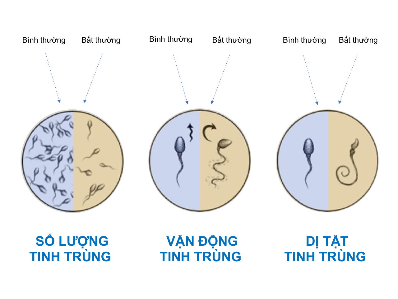 Chất lượng tinh trùng người Việt ngày càng giảm, tinh trùng loãng và bất thường?
