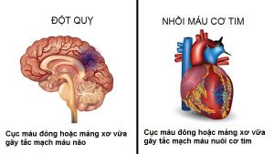 Vì Sao Cơn Đột Qụy Lại Hay Tấn Công Vào Buổi Sáng Sớm
